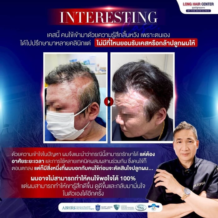 Hair Transplant on Scar. A Life-Changing: Baldness from a Severe Oil Burn