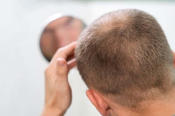 FUE Hair Transplant, Recell Hair Transplant