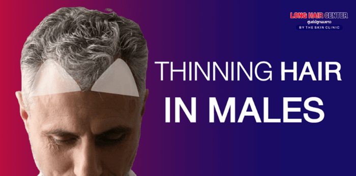 Thinning hair in men usually occur on the mid-scalp region (on top of the head) which can be found around 2 out of 3 in men. Another area is on the frontal region or hair line on top the forehead. If hair loss occurs in both areas, the risk of baldness could increase.