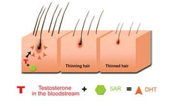 The primary culprit behind male pattern baldness is a hormone called DHT (Dihydrotestosterone). DHT binds to androgen receptors in hair follicles, disrupting the hair growth cycle. This leads to shorter growth phases and longer resting phases
