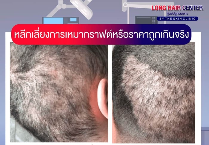What Is a Bulk Graft Hair Transplant?