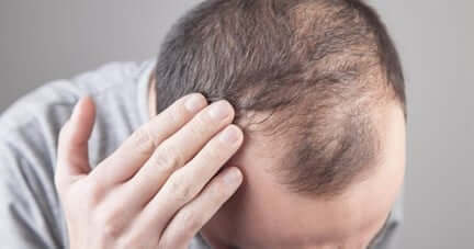 Medication for hair loss