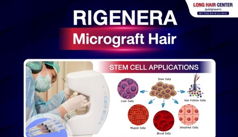 Rigenera Micrograft Hair