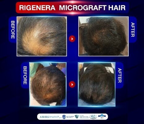 Exosome Rich Plasma
