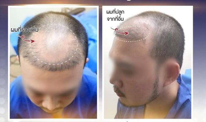 Case Example from The Skin Clinic Using ALMI Nano Fat Technique