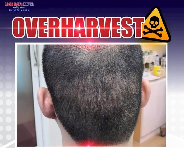 FUE Hair Transplant