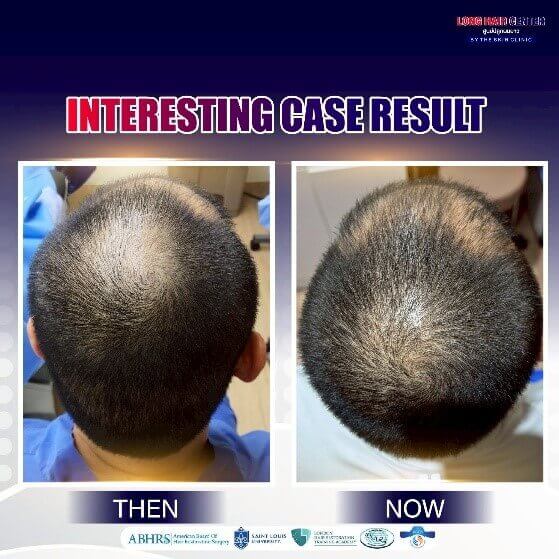 FUE Hair Transplant, Hair Transplant
