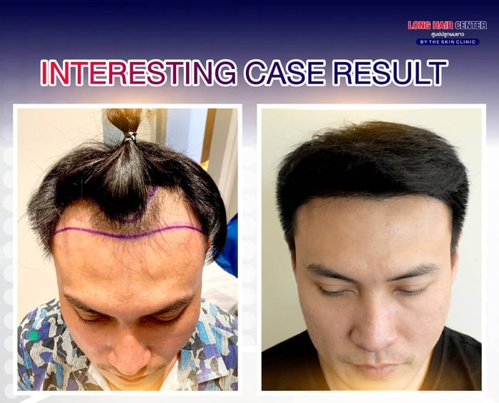 Is Hair Transplant the Final Solution? Can It Stop Hair Loss Completely?