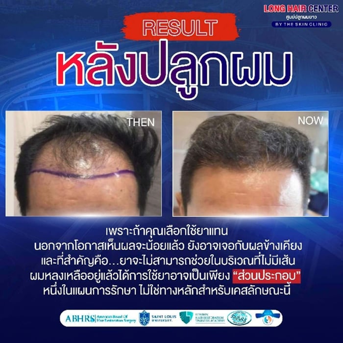 For those with clearly receding front hairlines, shiny scalp, and no remaining baby hairs, hair transplantation is also appropriate. A doctor may still recommend hair stimulation treatments to prolong the lifespan of existing hair that isn’t being transplanted.