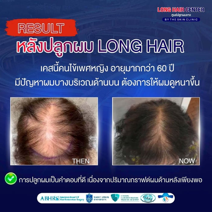When we're talking about hair loss issues, there are many options for treating hair thinning, whether it's medication, thickening treatments, or hair transplants