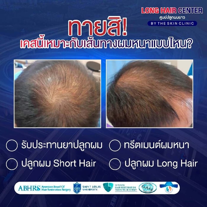 If you have diffuse thinning across the scalp but still have some fine hairs, don’t rush into a hair transplant just yet