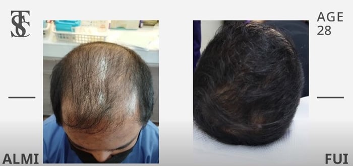 If you are facing hair loss or thinning, don’t lose hope just yet. You can book a consultation with The Skin Clinic to determine the cause and find the most suitable solution for you