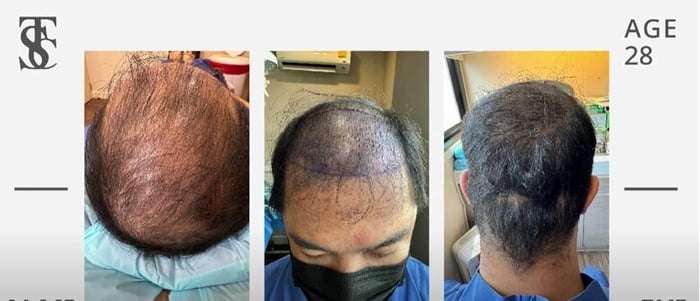 Combining the Regenera Activa and ALMI Nano Fat techniques stimulates new hair growth while strengthening existing hair, making it thicker hair and more robust