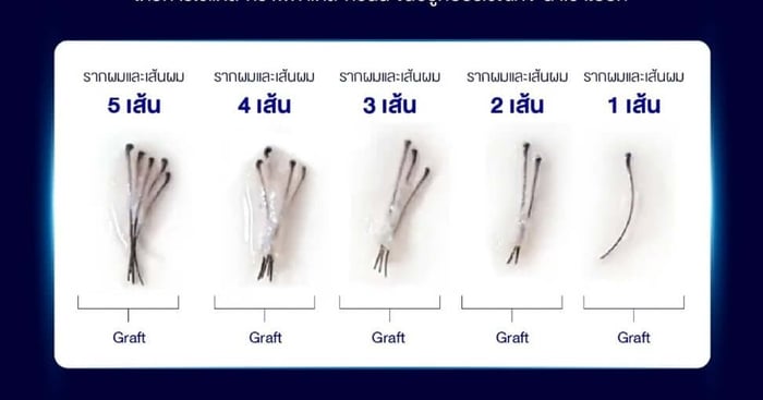 what-is-a-hair-graft-how-many-do-you-need-for-a-hair-transplant02.jpg