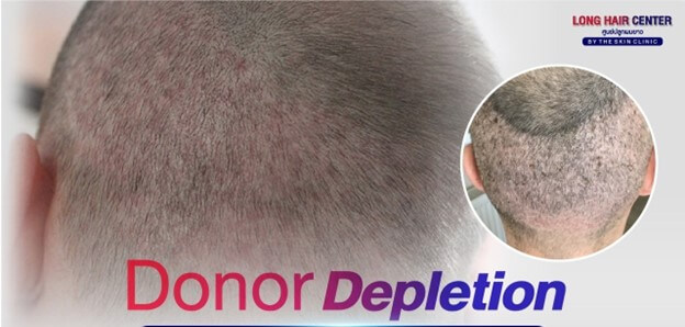 Common Misconceptions About Hair Transplantation.