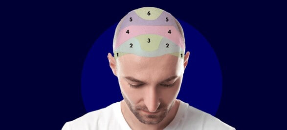 How Many Grafts Are Needed for a Hair Transplant? Factors Affecting Hair Graft Estimation