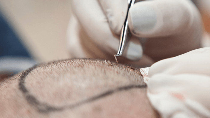 What is Hair Transplantation?