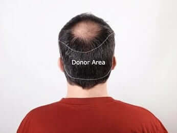 high density hair transplant