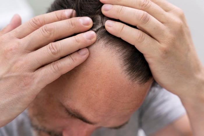 who-is-a-good-candidate-for-a-hair-transplant.jpg