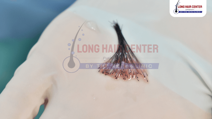 why-are-healthy-hair-grafts-important.png