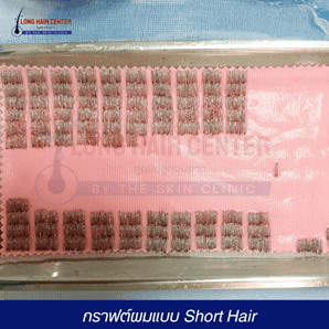 why-are-healthy-hair-grafts-important202401.png