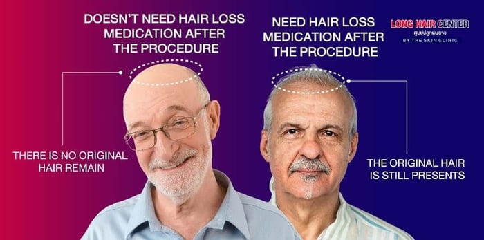 Why some cases need to take a medication and some don’t? hair loss treatment