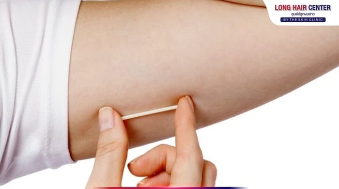 The birth control implant is a convenient and highly effective contraceptive method. However, some individuals may experience hair loss as a side effect due to hormonal fluctuations