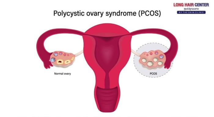 PCOS is a condition caused by hormonal imbalances, affecting reproductive health and leading to elevated androgen (male hormone) levels. This can cause thinning hair