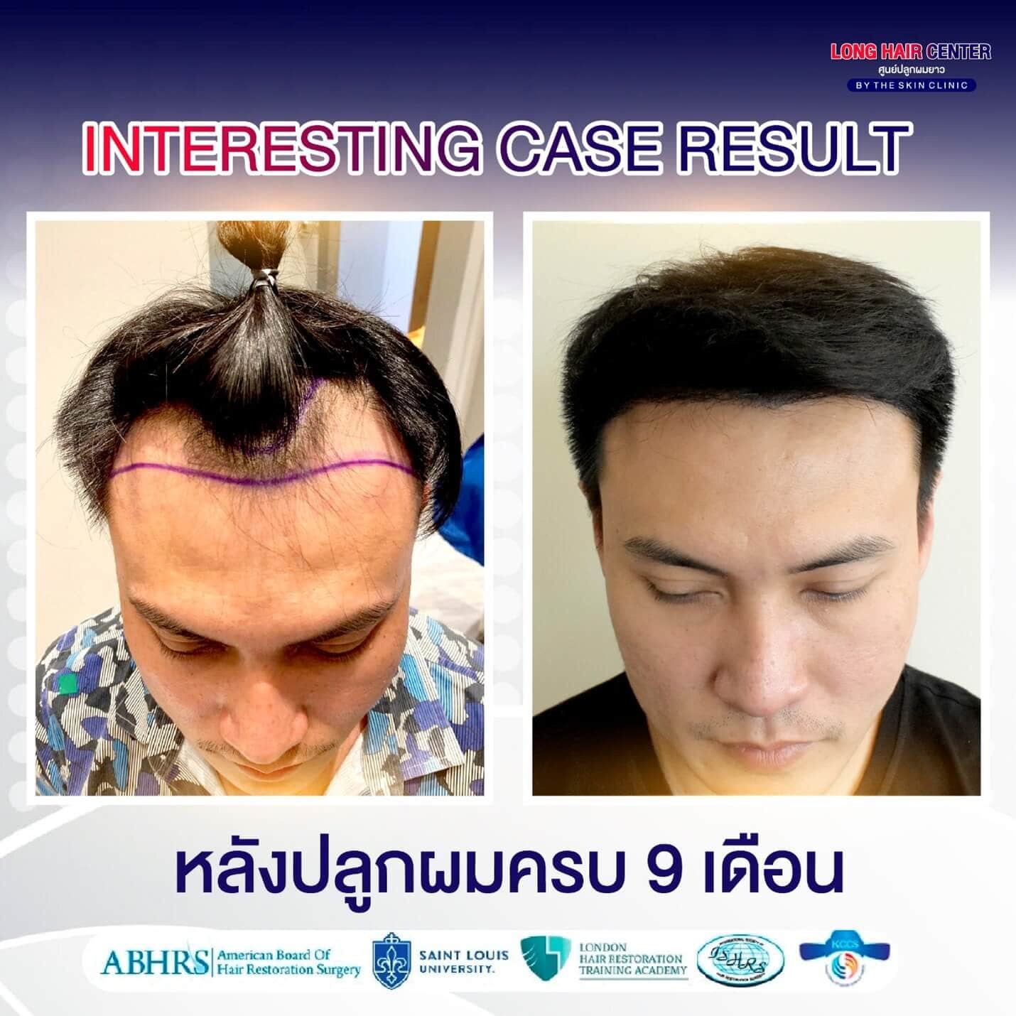 คลินิกปลูกผม, ปลูกผม FUE