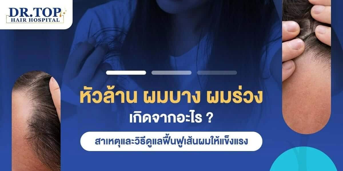 หัวล้าน ผมบาง ผมร่วงเกิดจากอะไร ? สาเหตุและวิธีดูแลฟื้นฟูเส้นผมให้แข็งแรง