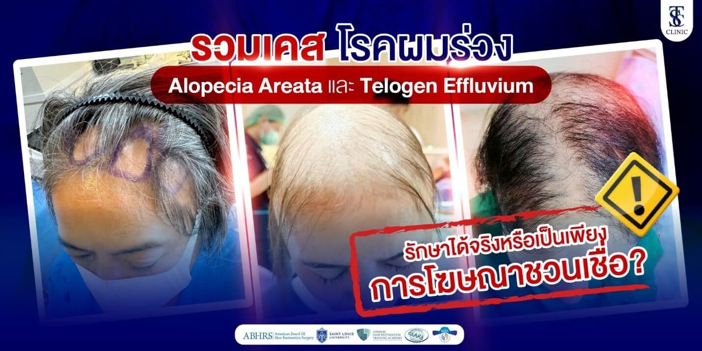 โรคผมร่วง Alopecia Areata และ Telogen Effluvium รักษาได้จริงไหม?