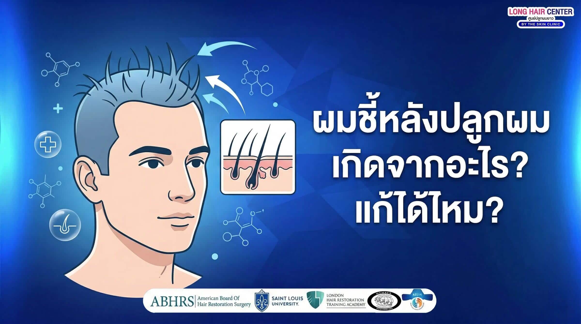 ผมชี้หลังปลูกผม = ปลูกพลาดจริงไหม? รู้สาเหตุ + วิธีแก้ก่อนสายเกินไป