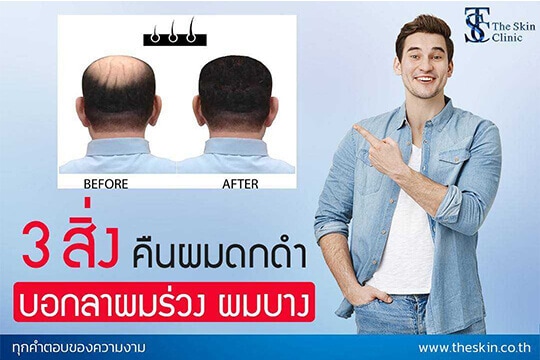 3 สิ่ง คืนผมดกดำ บอกลา ผมร่วง ผมบาง