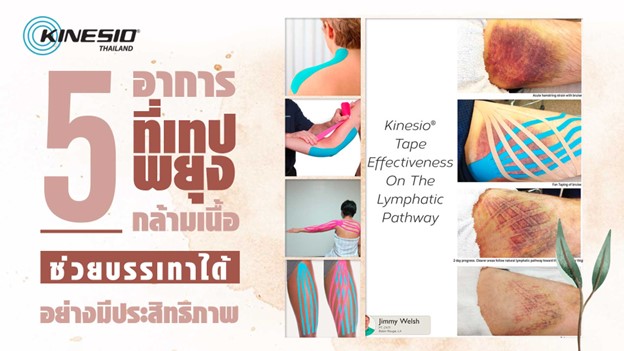 5 อาการที่เทปพยุงกล้ามเนื้อช่วยบรรเทาได้อย่างมีประสิทธิภาพ