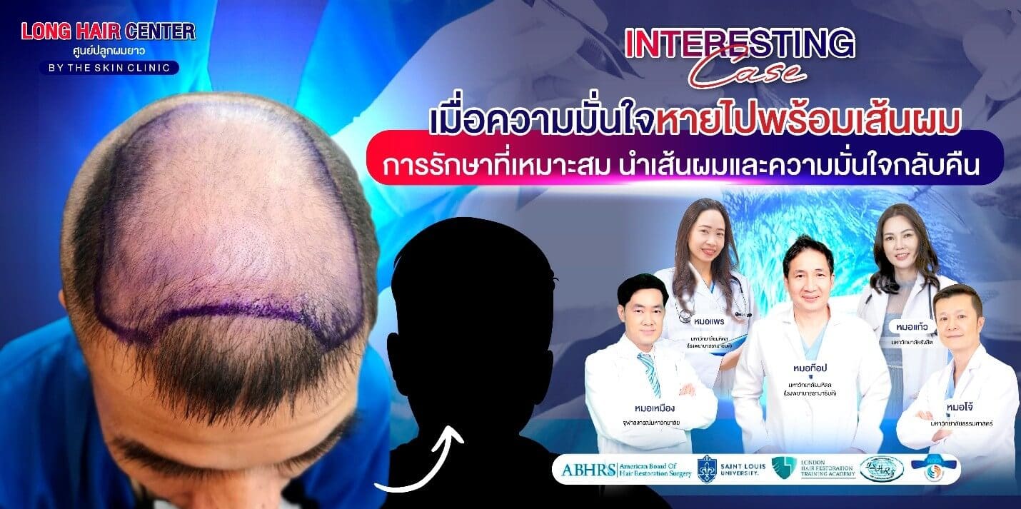 รีวิวปลูกผม: ปลูกผมผู้ชาย กู้คืนความมั่นใจด้วย เทคนิค Short Hair x ALMI Nano Fat