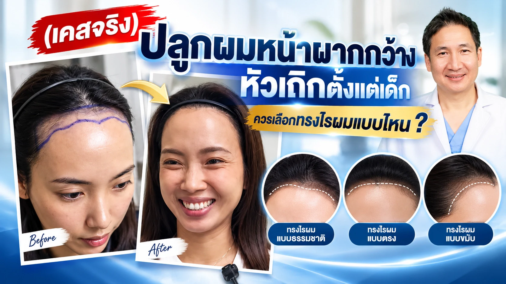 (เคสจริง) ปลูกผมหน้าผากกว้าง หัวเถิกตั้งแต่เด็ก ควรเลือกทรงไรผมแบบไหน