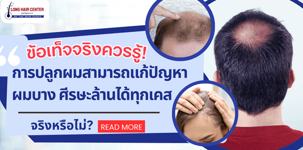 ปลูกผมแล้วต้องกินยาไปตลอดชีวิตหรือไม่?
