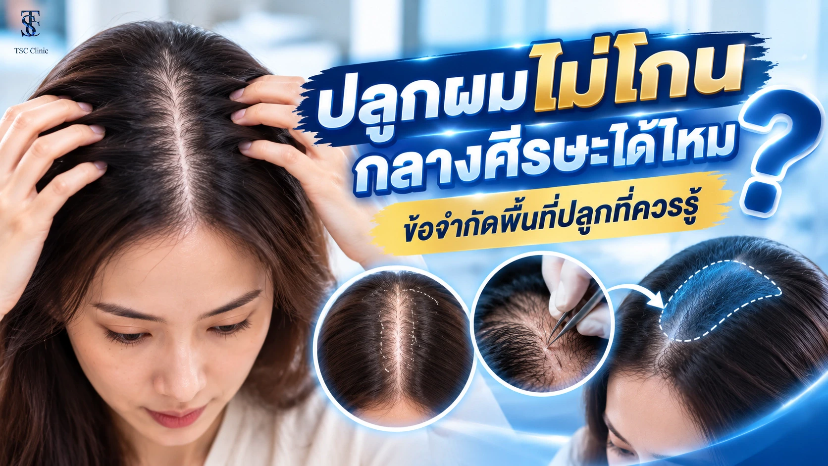 ผมบางกลางศีรษะที่ยังมีผมเดิมคลุม ก่อนประเมินการปลูกผมแบบไม่โกน