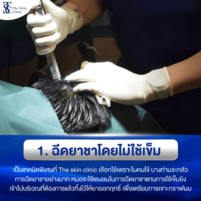 ฉีดยาชาโดยไม่ใช้เข็ม