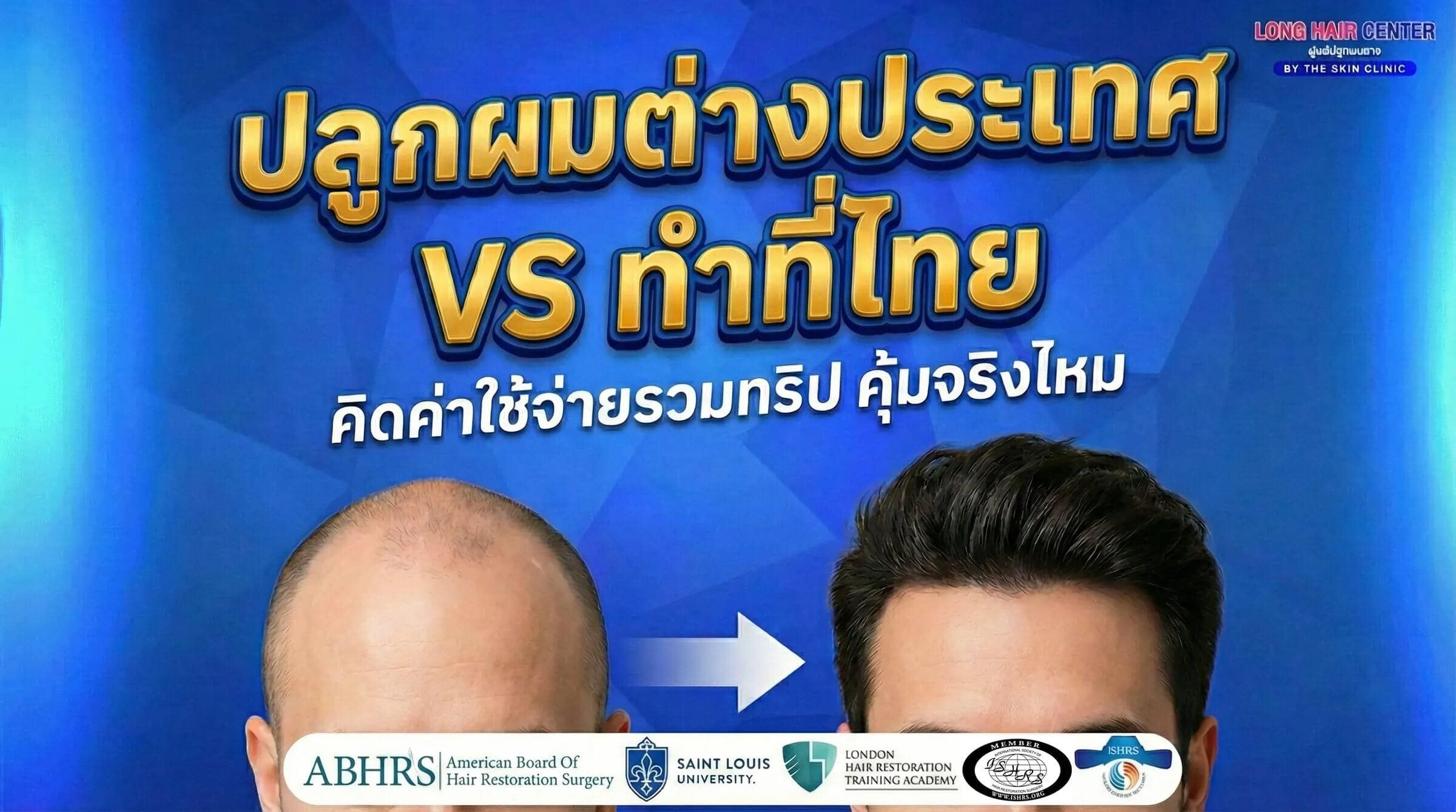 ปลูกผมต่างประเทศ vs ไทย 2026 ที่ไหนคุ้มค่ากว่า?