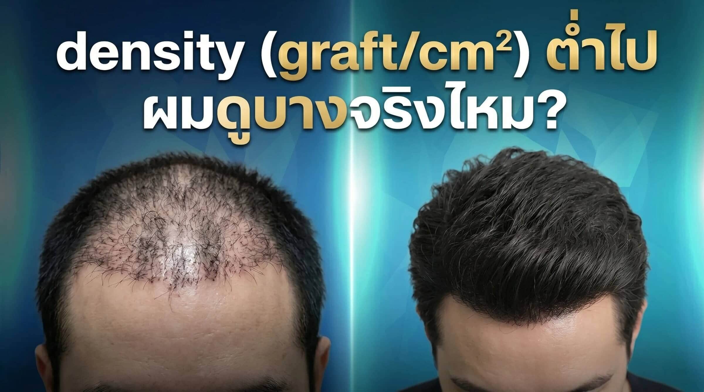 เปรียบเทียบความหนาแน่นกราฟต์ปลูกผม density สูงและต่ำ
