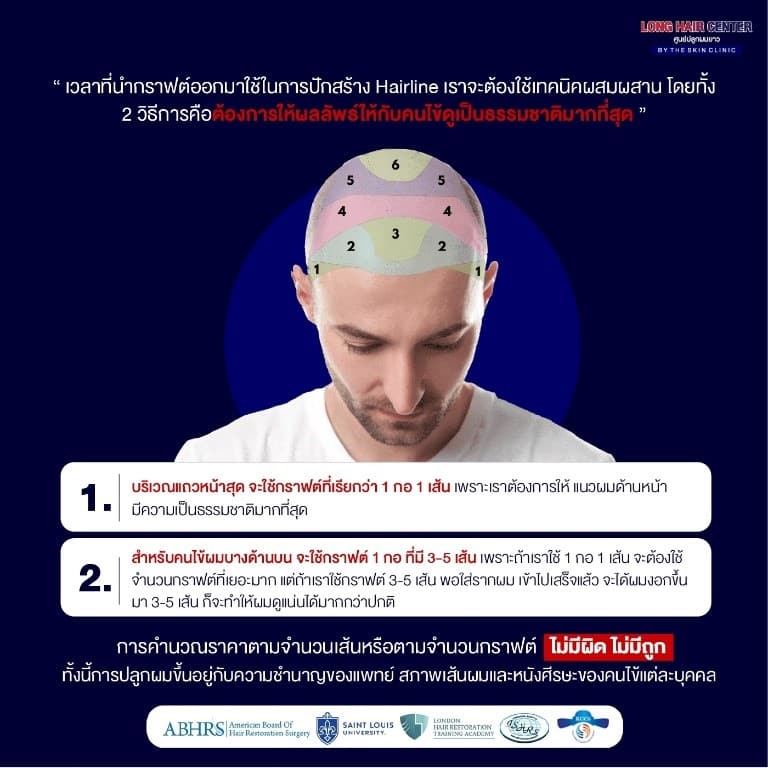 ศัลยกรรมปลูกผม, ปลูกผม FUE