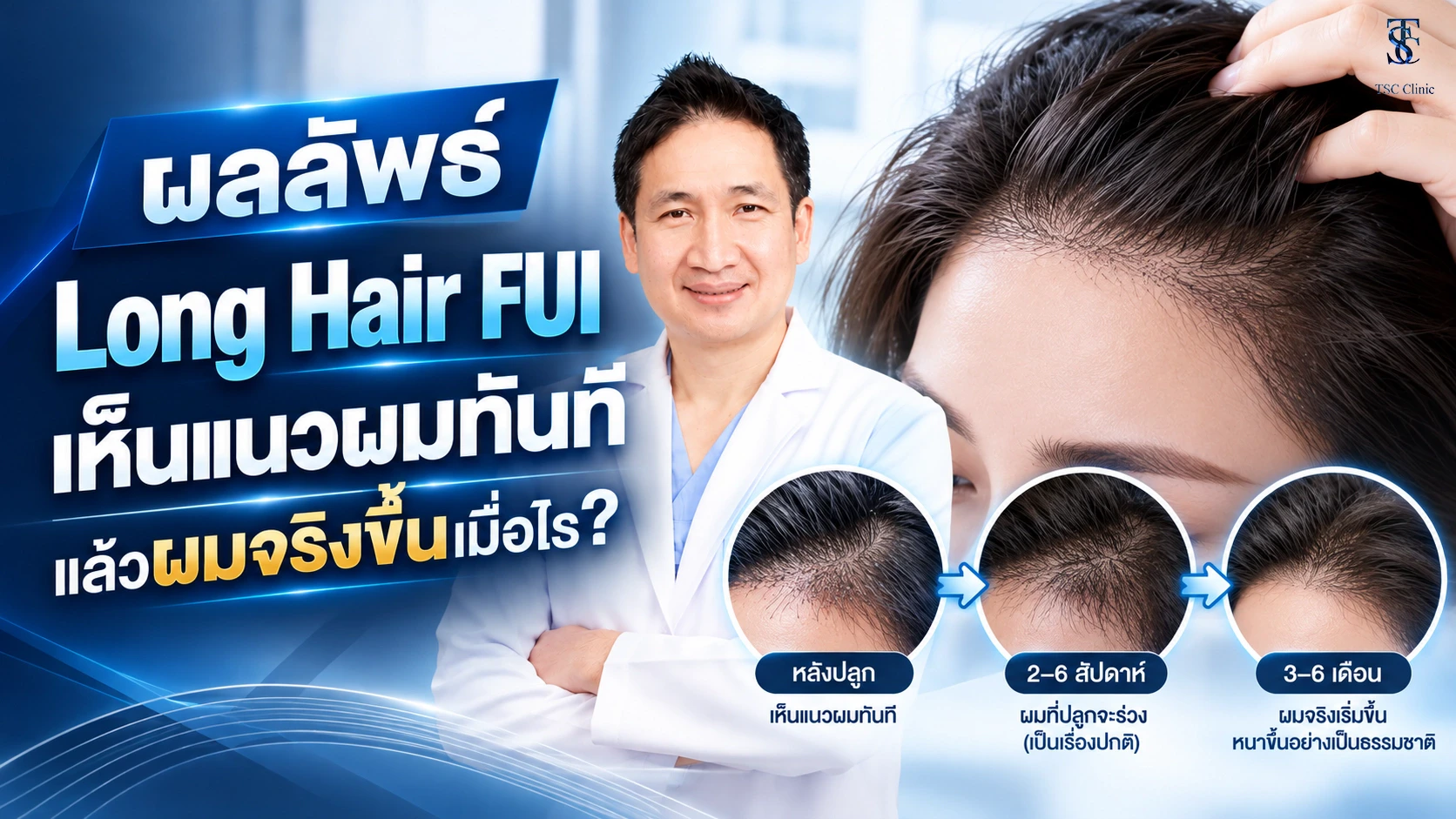 แนวผมที่เห็นทันทีหลังปลูกผมแบบ Long Hair FUI ไม่ต้องโกนผม