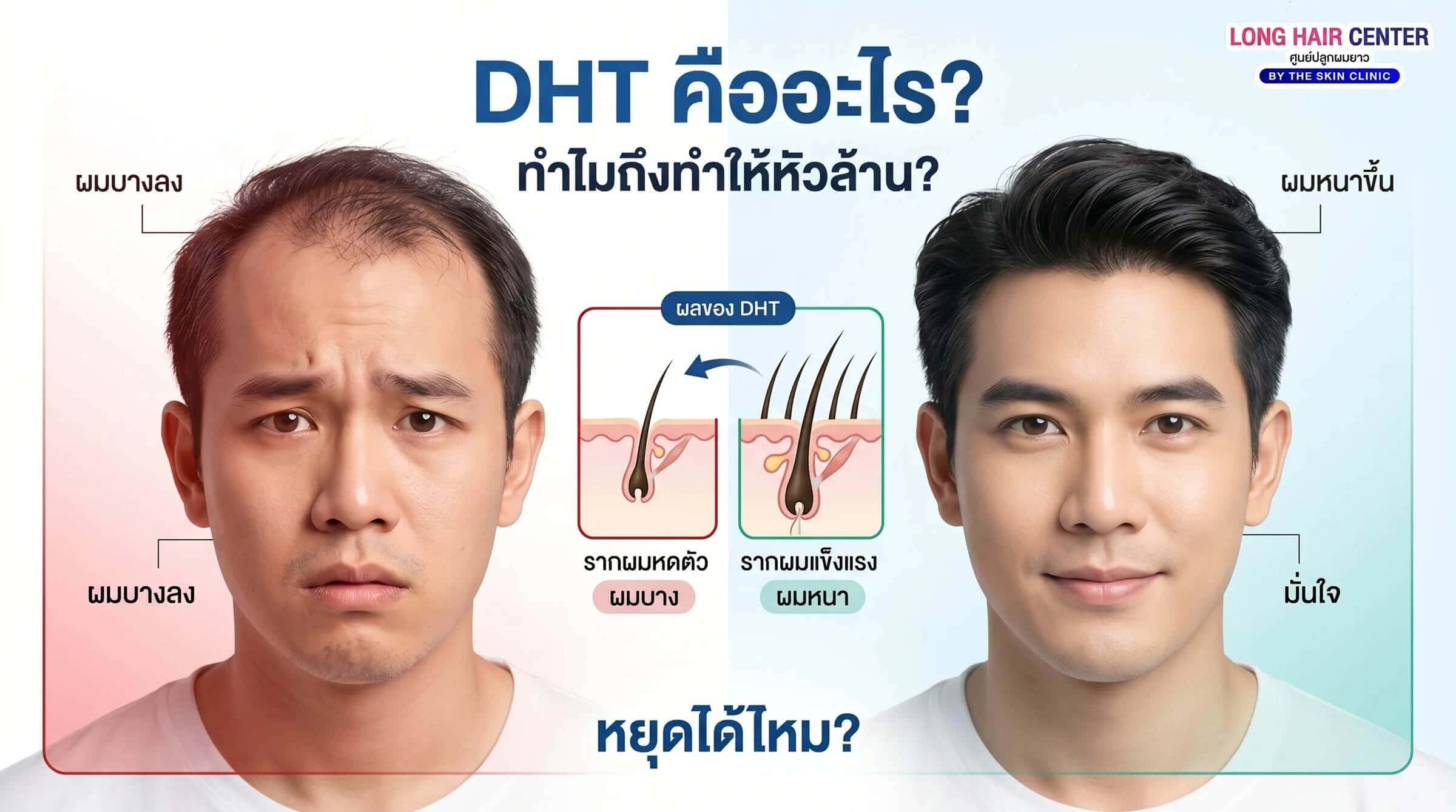 DHT Hormone ต้นเหตุผมร่วงและหัวล้านจากกรรมพันธุ์