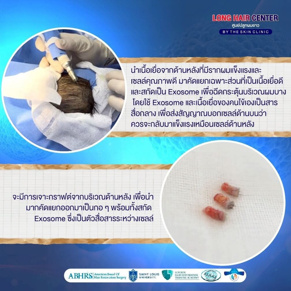 ทำไมต้องใช้เซลล์รากผมจากด้านหลังศีรษะ?
