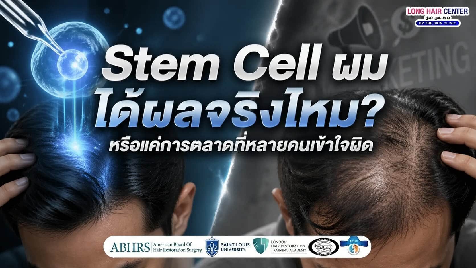 Stem Cell ผม ได้ผลจริงไหม? หรือแค่การตลาดที่หลายคนเข้าใจผิด