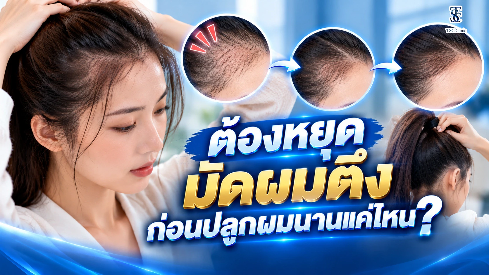 ผมร่วงจากมัดผมตึง ต้องหยุดพฤติกรรมนานแค่ไหนก่อนปลูกผม