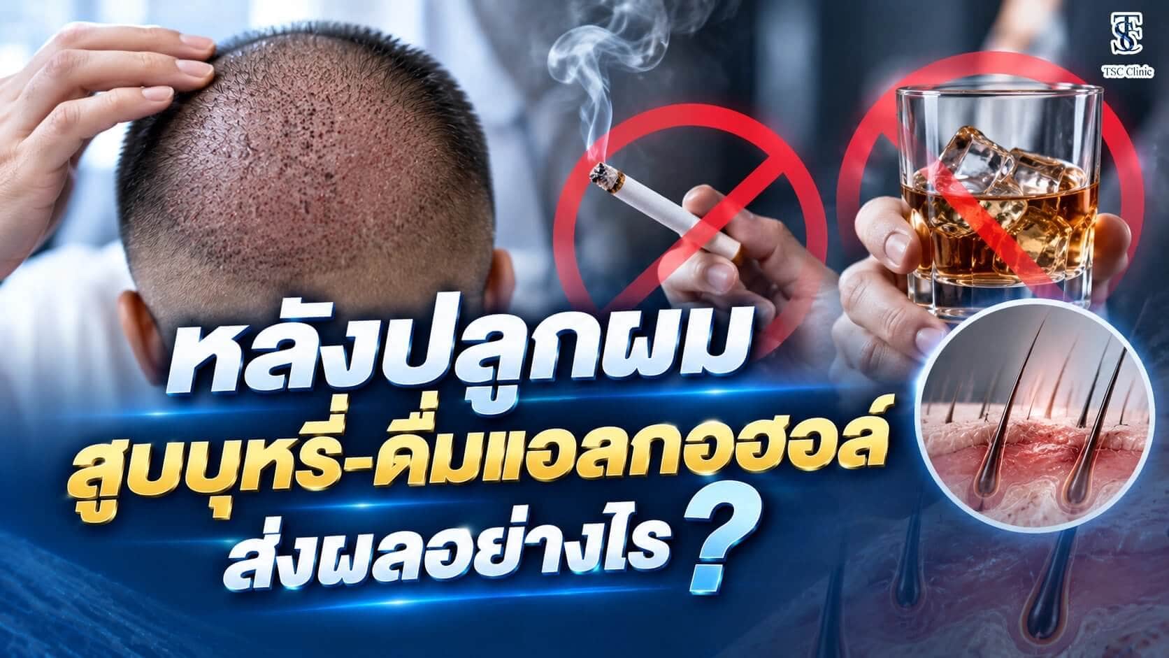 หลังปลูกผม สูบบุหรี่หรือดื่มแอลกอฮอล์มีผลอย่างไรต่อการรอดของกราฟต์