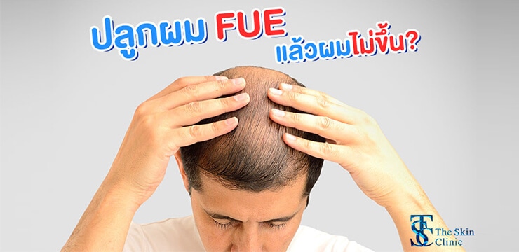 ปลูกผมแบบ FUE ไม่ได้ผล ผมไม่ขึ้นอย่างที่คาดหวัง