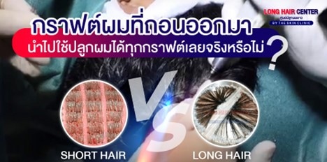 ปลูกผมแล้วต้องกินยาไปตลอดชีวิตหรือไม่?